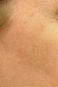 Can Dark Spots be Treated?: Specialists in Dermatology PLLC