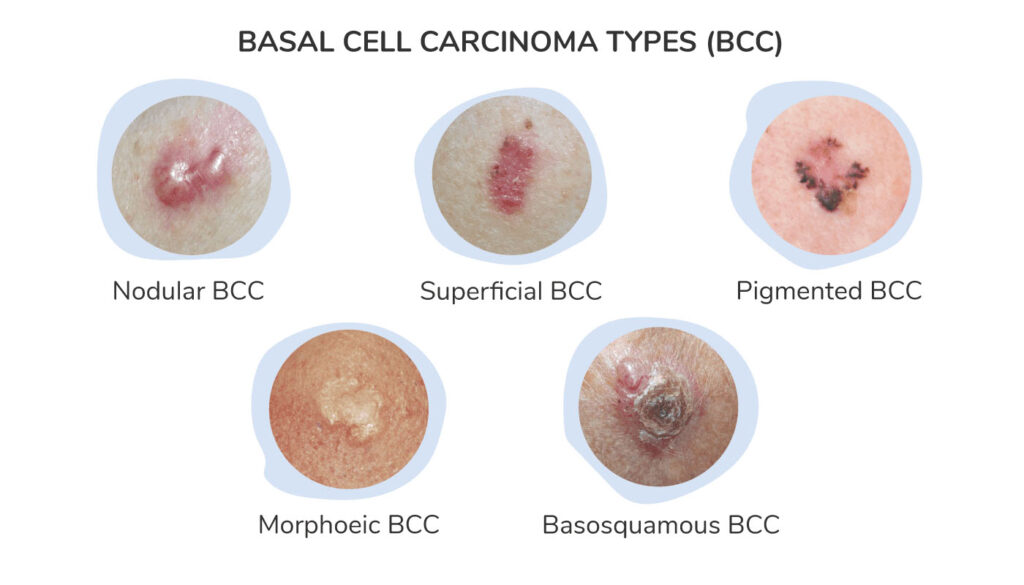 Skin Cancer - Basal Cell Carcinoma - Dyson Dermatology Tucson, AZ