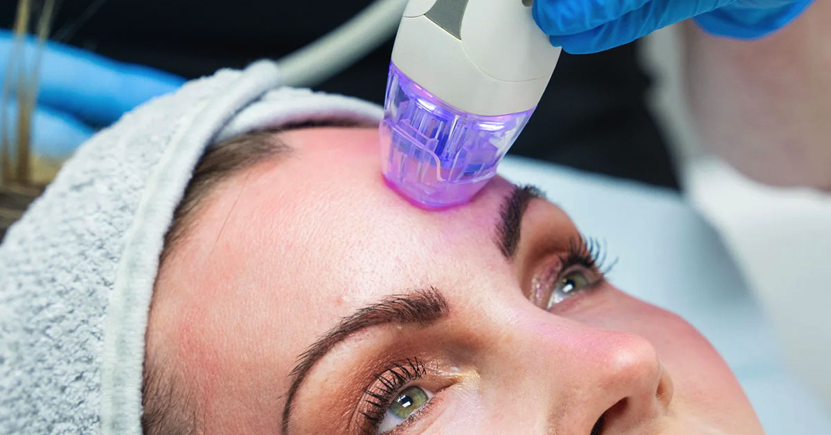 RF Microneedling - Dyson Dermatology